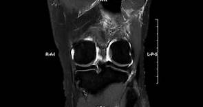 Chondral injury of the knee - complete MRI examination