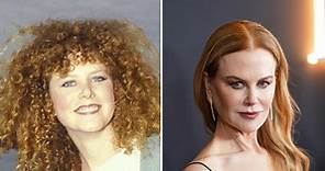 Nicole Kidman Plastic Surgery: Before and After Photos