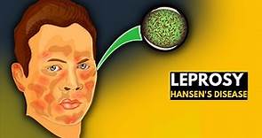 Leprosy (Hansen's disease): Everything You Need to Know