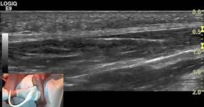 Ultrasound tutorial - Imaging of the plantar fascia