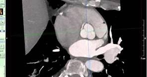 Coronary CT Angiography: Anomalous RCA