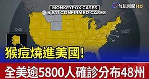 猴痘燒進美國! 全美逾5800人確診分布48州