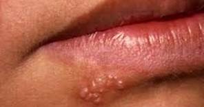 9 Remedios caseros para tratar y curar rapidamente el herpes labial