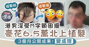 脫髮困擾｜港男豪花6.5萬北上植髮　3個月後公開成果：變成咁 - 香港經濟日報 - TOPick - 健康 - 健康資訊