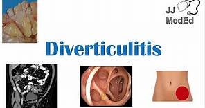 Diverticulitis: Risk Factors (ex. Low Fiber Diets), Symptoms, Diagnosis, Treatment and Complications