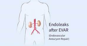 Endoleaks after Endovascular Repair of Thoracic Aortic Aneurysms (EVAR)