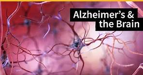 How Alzheimer's Changes the Brain