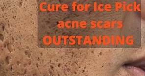 How to treat ice pick acne scars