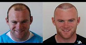 Wayne Rooney - Hair Transplant