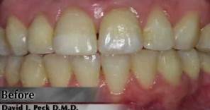 BriteSmile™ Teeth Whitening Boston, Massachusetts