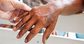Qué es la lepra, síntomas, causas y cómo se contagia