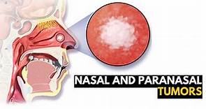 Nasal and Paranasal Tumors, Causes, Signs and Symptoms, Diagnosis and Treatment.