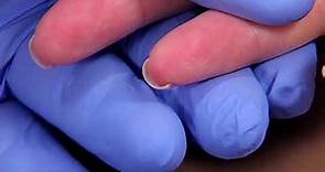 Perform a Capillary Puncture Obtain a Blood Sample by Capillary Puncture