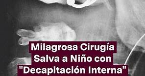 En una operación extremadamente rara, los cirujanos del Centro Médico Hadassah, en Israel, han vuelto a unir la cabeza al cuello de un niño de 12 años tras un grave accidente en el que fue atropellado por un coche mientras montaba en bicicleta. Suleiman Hassan, palestino de Cisjordania, fue trasladado por vía aérea a la unidad de traumatología del hospital Hadassah de Ein Kerem, donde se determinó que los ligamentos que sujetaban la base posterior de su cráneo estaban gravemente dañados, por lo 