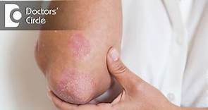 How to identify Seborrheic Dermatitis? - Dr. Rasya Dixit