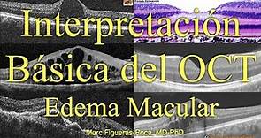 Interpretación Básica del OCT. Edema Macular.