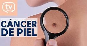Todo lo que debes saber sobre el cáncer de piel