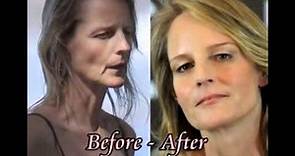 Helen Hunt plastic surgery before and after photos