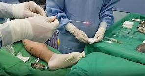 靜脈曲張治療：微創靜脈腔內雷射閉合手術如何做？｜許原彰醫師：台中，高雄，台南，台北，新竹，靜脈曲張專家