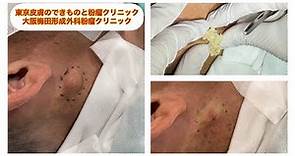 クビの粉瘤 ブログでも粉瘤について詳しく解説してます。東京皮膚のデキモノと粉瘤クリニック ふるばやし形成外科 東京新宿院 大阪梅田形成外科クリニック