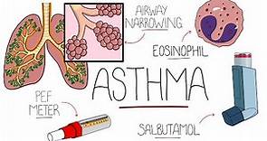 Asthma Explained (Including Pathophysiology)