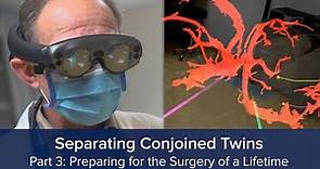 Separating Conjoined Twins Part 3: Preparing for the Surgery of a Lifetime