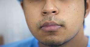 How to remove lip scar, improve shape and make in more Handsome
