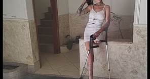 A beautiful woman with an amputated leg walks with crutches | amputee | crutching | prosthetic