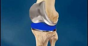 Total Knee Replacement Surgery (Arthroplasty) - University of Vermont Medical Center, Vermont