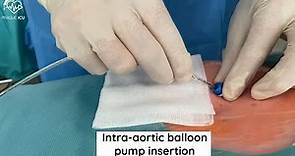 Intra-aortic balloon pump insertion