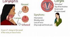 Laryngitis - Symptoms, causes and treatment