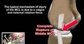 Medial Collateral Ligament Injuries - Everything You Need To Know - Dr. Nabil Ebraheim