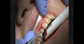 半导体激光治疗仪牙周刮治术