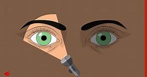 Pupillen Untersuchung (Pupillendiagnostik)
