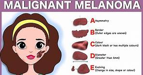 Malignant melanoma: Signs, Pathophysiology, Types, Diagnosis, Treatment