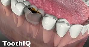 Dental Abscesses (480p)