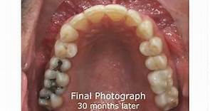 Upper Teeth Shifting with Braces - Orange County Orthodontist (Dr. Evelyn Maruko)