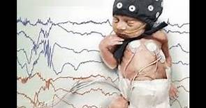 Crisis convulsivas neonatales