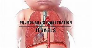 Pulmonary sequestration notes