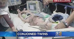 Separating Conjoined Twins