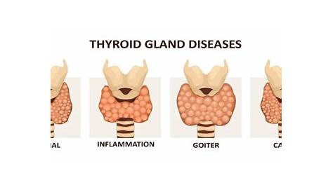 what size thyroid nodule is concerning