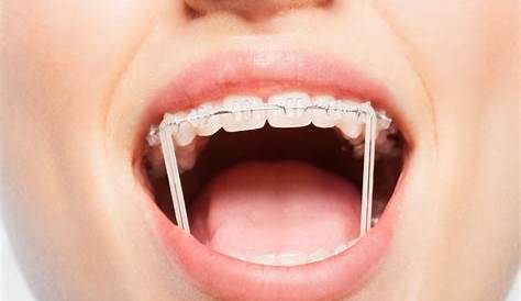 Orthodontics Australia | Elastics For Braces: Rubber Bands in Orthodontics