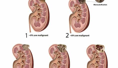 What Is Cyst In Kidney - HealthyKidneyClub.com