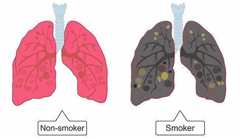 Smokers Lungs After Smoking