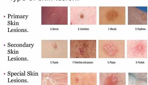 types of skin lesions chart