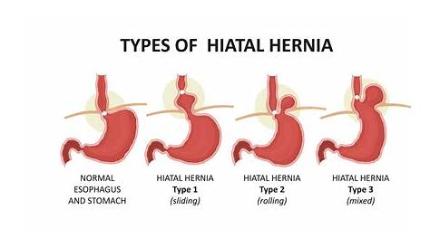how small can a hernia be