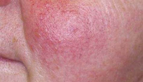 vascular skin lesions pictures