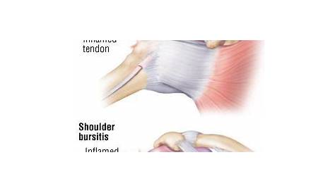 Rotator Cuff Injury Guide: Causes, Symptoms and Treatment Options | Het