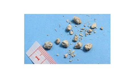 What Size Of Kidney Stones Require Surgery? - Pristyn Care
