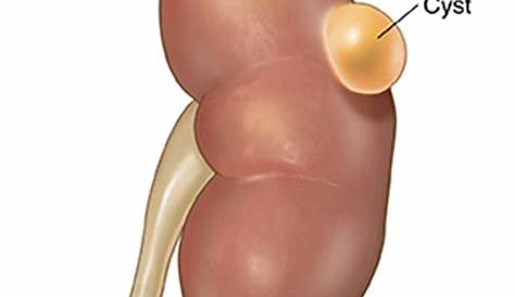 Simple Kidney Cysts | Saint Luke's Health System